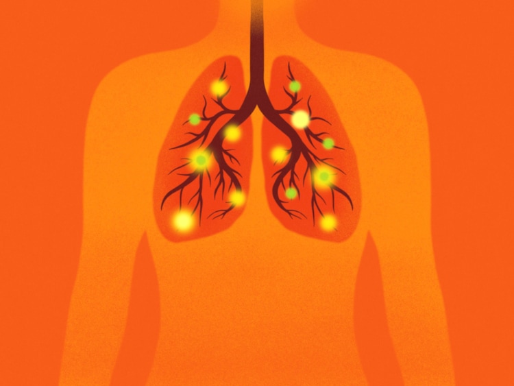 Mortality rates in severe pulmonary cases can reach nearly 38%, particularly once serious breathing difficulties begin. (Photo: Getty Images)