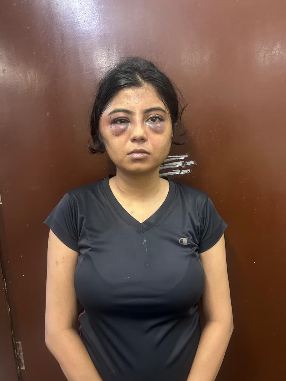The victim had bruises beneath her eyes due to the alleged assault by her boyfriend.