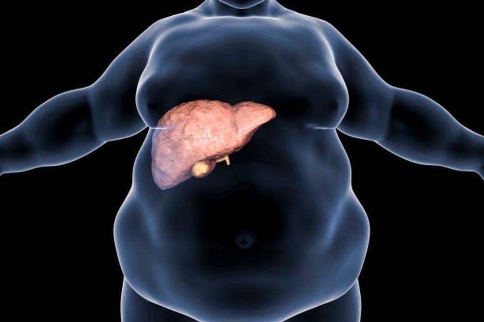 Fatty Liver