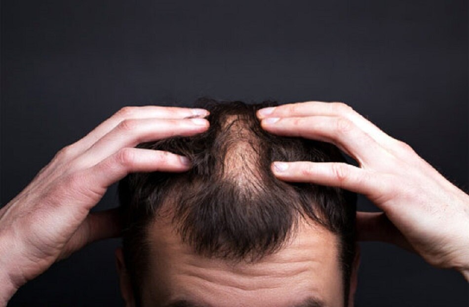 শীতের খুশকির জন্য ঘরোয়া প্রতিকার হল আমলকির গুঁড়ো এবং তেজপাতা শীতের খুশকির জন্য ঘরোয়া প্রতিকার হল আমলকির গুঁড়ো এবং তেজপাতা