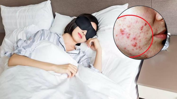 Acne Reasons & Remedies ঘুমের আগে করা এই ভুলে হতে পারে ব্রণ, সুস্থ