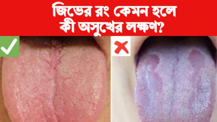 White Tongue Signs যৌন রোগ থেকে রক্তাল্পতা, জিভের রং দেখে বুঝে নিন কী