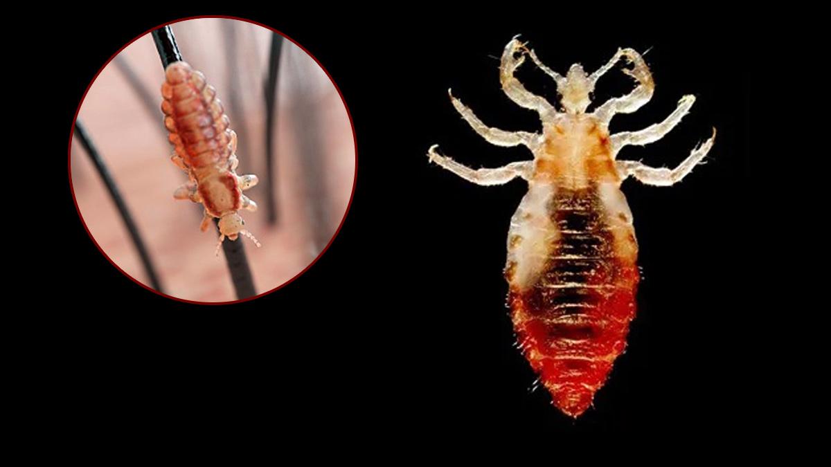Lice Remedies মাথায় উকুন বাসা বেঁধেছে? জানুন তাড়ানোর ঘরোয়া টোটকা