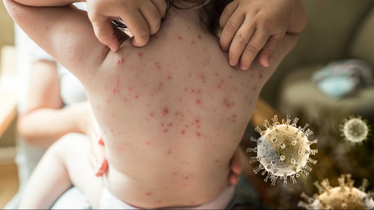 Chicken Pox Diet: বসন্তের আগেই দেখা দিচ্ছে চিকেন পক্স! দ্রুত নিরাময়ে