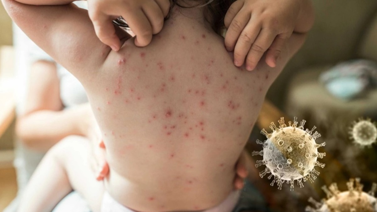 Chicken Pox: আপনারও হতে পারে চিকেন পক্স, কোন কোন লক্ষণ দেখে বুঝবেন