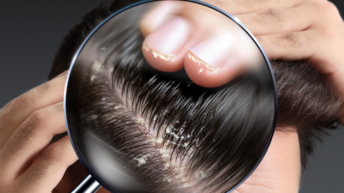 The truth about oily sticky dandruff everyone needs to know and ways to tackle it