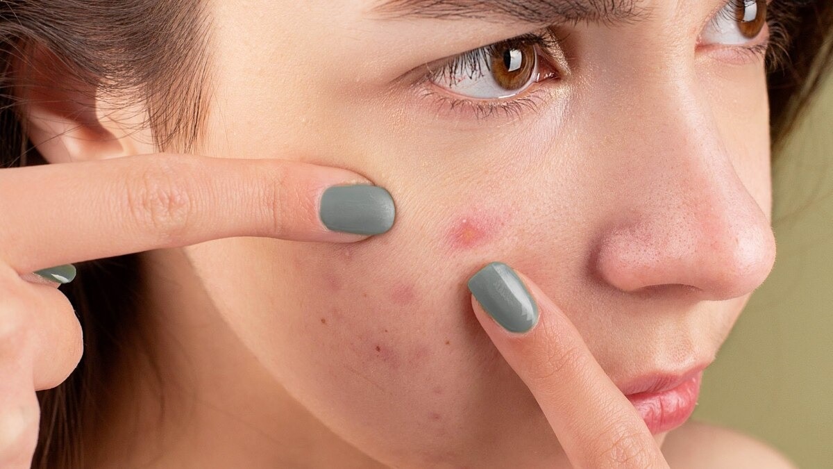 Behold: The best skincare routine for acne in 2025, according to dermatologists