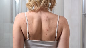 The dermatologist-approved ways to get rid of bacne, and the products to use The dermatologist-approved ways to get rid of bacne, and the products to use
