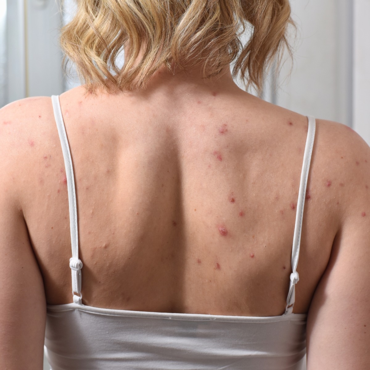 The dermatologist-approved ways to get rid of bacne, and the products to use