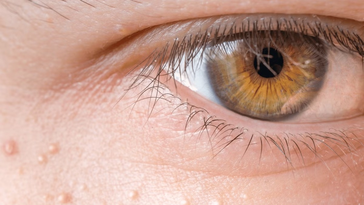 How to get rid of milia, according to a dermatologist