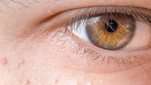 How to get rid of milia, according to a dermatologist How to get rid of milia, according to a dermatologist