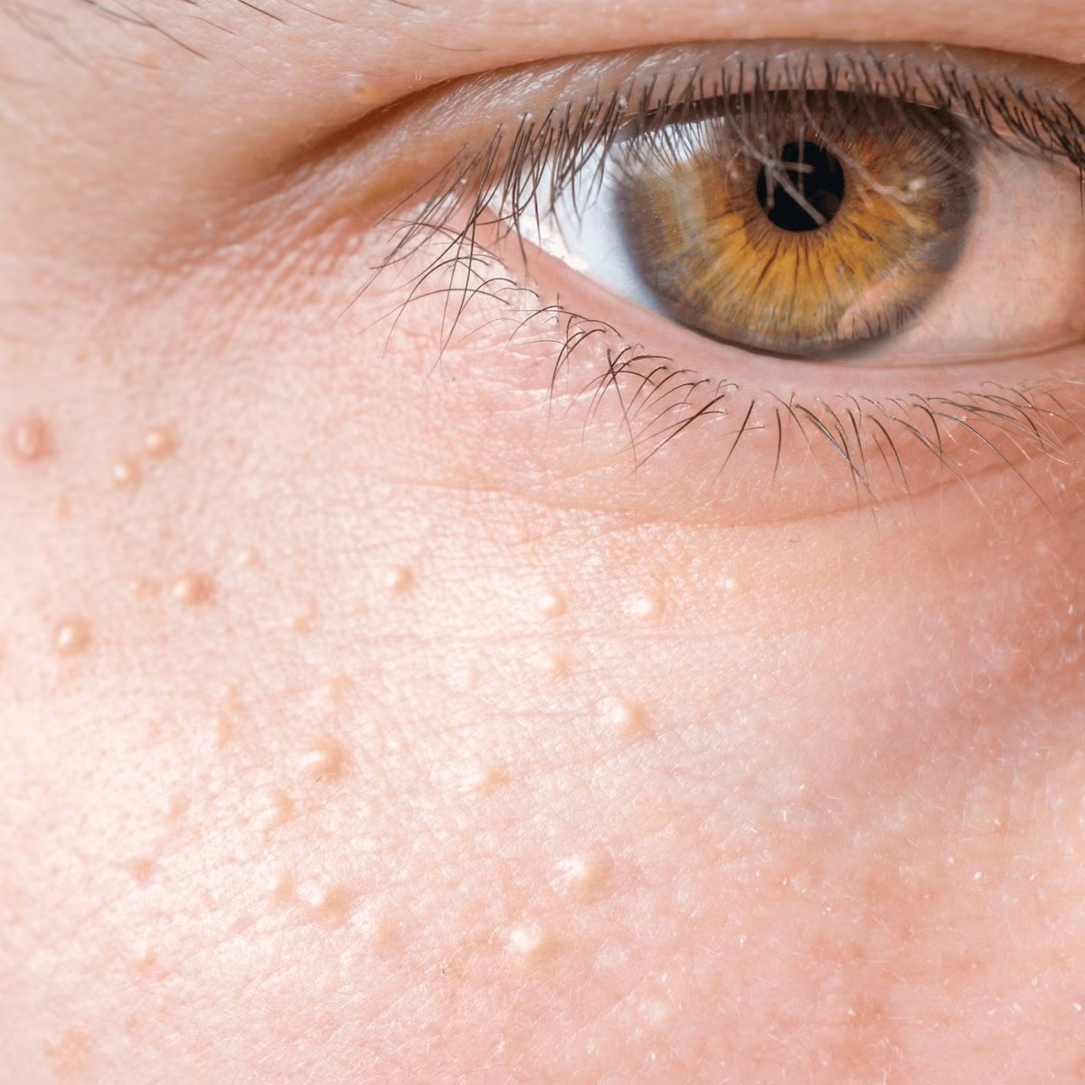 How to get rid of milia, according to a dermatologist