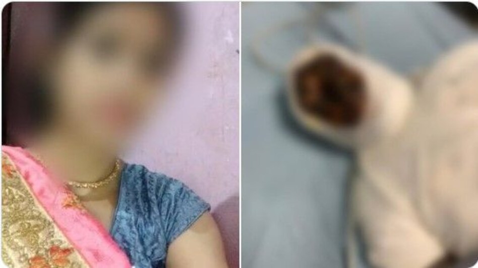 शादी से किया इनकार तो महिला के चेहरे पर फेंका तेज़ाब, पीड़िता के बच्चों को रो-रोकर बुरा हाल, पूछते हैं मां कब आएगी? शादी से किया इनकार तो महिला के चेहरे पर फेंका तेज़ाब, पीड़िता के बच्चों को रो-रोकर बुरा हाल, पूछते ...