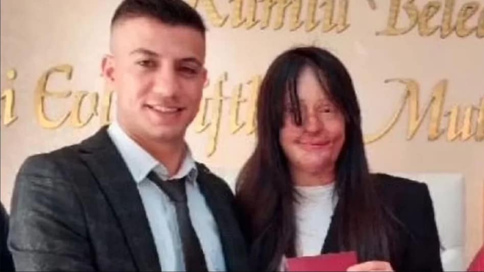 चेहरे पर एसिड फेंकने वाले के प्यार में दीवानी हुई महिला, जेल से बाहर आते ही कर ली शादी! चेहरे पर एसिड फेंकने वाले के प्यार में दीवानी हुई महिला, जेल से बाहर आते ही कर ली शादी!