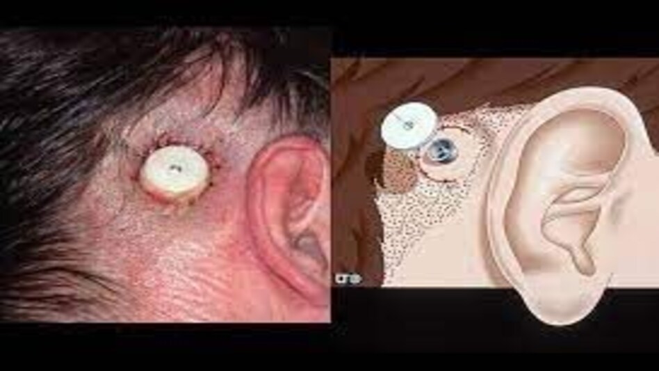 ये छात्र तो नकल में मुन्ना भाई MBBS का भी बाप निकला, सर्जरी से कान में फिट करा लिया ब्लूटूथ ये छात्र तो नकल में मुन्ना भाई MBBS का भी बाप निकला, सर्जरी से कान में फिट करा लिया ब्लूटूथ