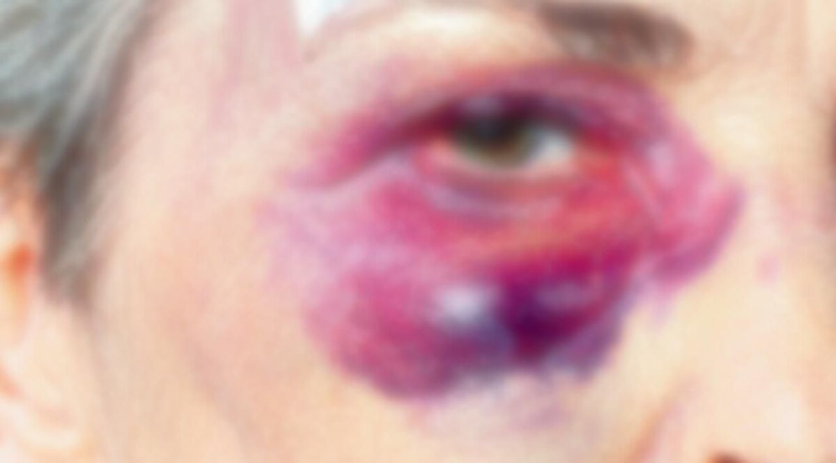 उसने तो पत्थर फेंक कर महिला की आंख बिगाड़ दी, क़ानून उसका कुछ भी नहीं बिगाड़ सकता! CrimeTak