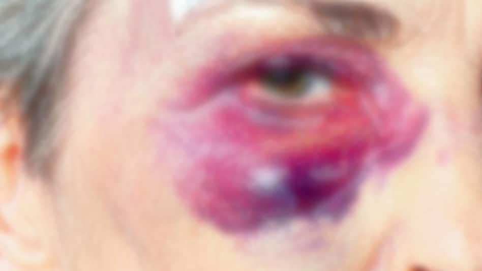 उसने तो पत्थर फेंक कर महिला की आंख बिगाड़ दी, क़ानून उसका कुछ भी नहीं बिगाड़ सकता! उसने तो पत्थर फेंक कर महिला की आंख बिगाड़ दी, क़ानून उसका कुछ भी नहीं बिगाड़ सकता!