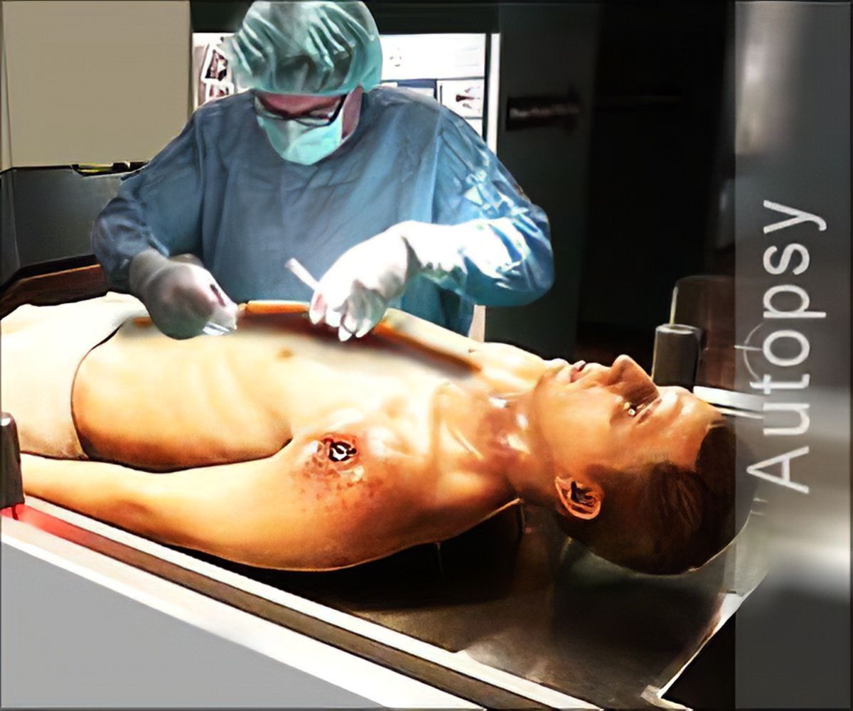 WHAT IS POSTMORTEM ? पोस्टमार्टम क्या होता है ? WHAT IS POSTMORTEM ? पोस्टमार्टम क्या होता है ?