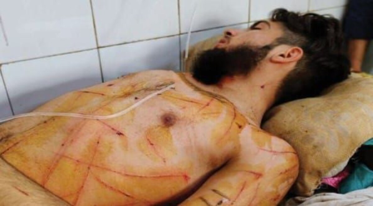 प्यार या पागलपन : बीवी रूठ कर मायके गई तो इस युवक ने गर्म चाकू से शरीर पर बना लिए 100 जख्म, इस बात पर हुई थी दोनों में अनबन CrimeTak