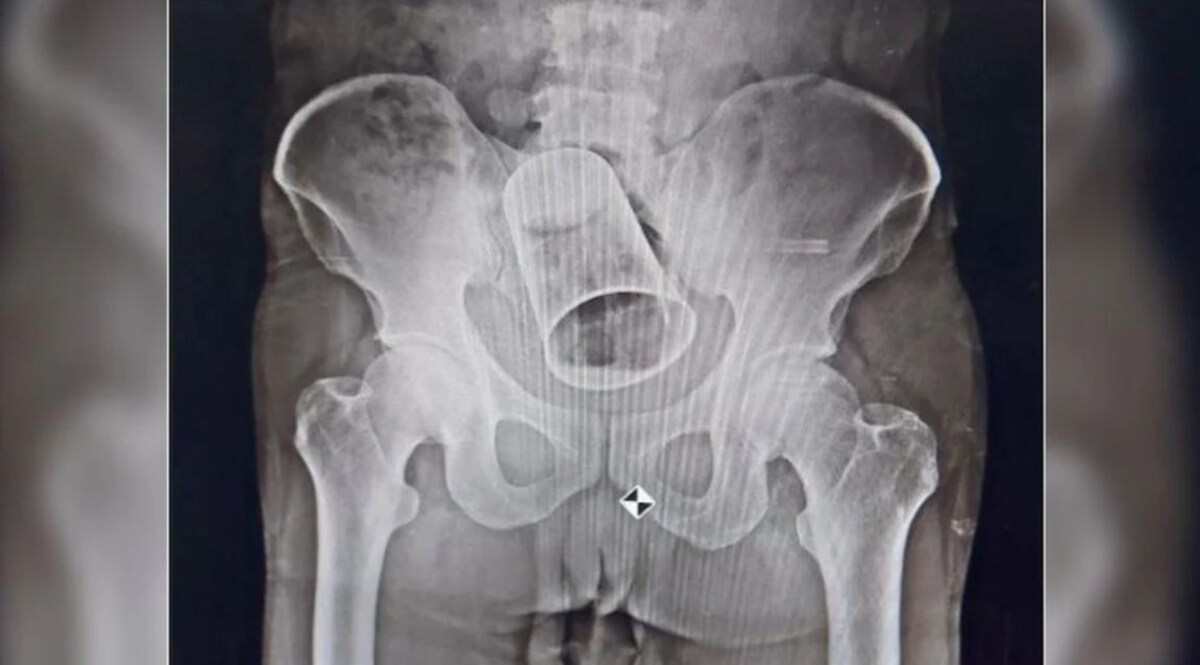 दोस्तों ने इस वजह से प्राइवेट पार्ट में स्टील का गिलास डाल दिया, X-ray रिपोर्ट में खुला ये राज CrimeTak