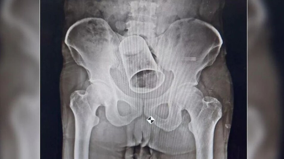 दोस्तों ने इस वजह से प्राइवेट पार्ट में स्टील का गिलास डाल दिया, X-ray रिपोर्ट में खुला ये राज दोस्तों ने इस वजह से प्राइवेट पार्ट में स्टील का गिलास डाल दिया, X-ray रिपोर्ट में खुला ये राज