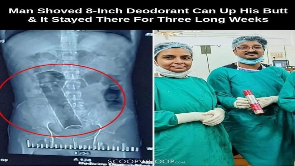 West Bengal News: ... अपने प्राइवेट पार्ट में डाल लिया Deodorant का सिलेंडर, ऐसे निकाला गया ? West Bengal News: ... अपने प्राइवेट पार्ट में डाल लिया Deodorant का सिलेंडर, ऐसे निकाला गया ?