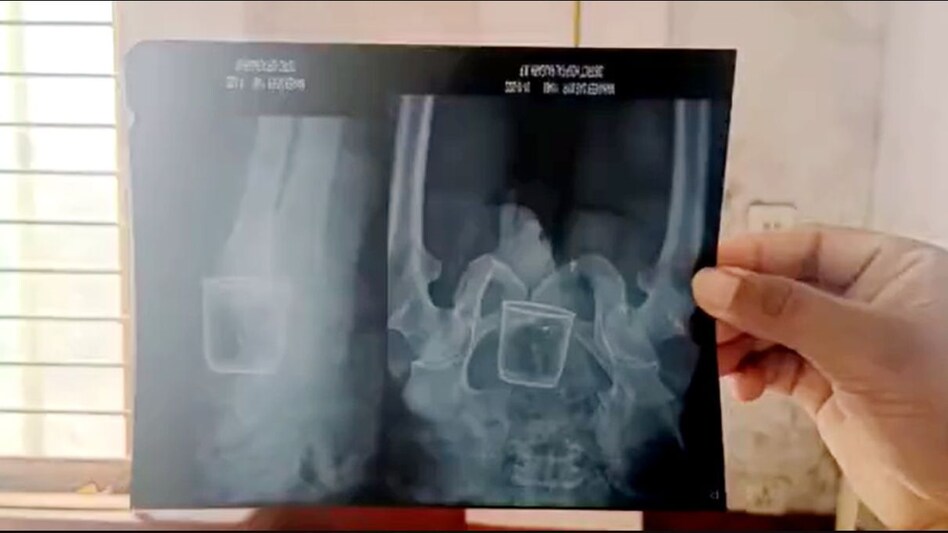 Viral News: बूढ़े शख्स के प्राइवेट पार्ट में स्टील का गिलास डाल दिया, X-ray रिपोर्ट में खुला ये राज Viral News: बूढ़े शख्स के प्राइवेट पार्ट में स्टील का गिलास डाल दिया, X-ray रिपोर्ट में खुला ये राज