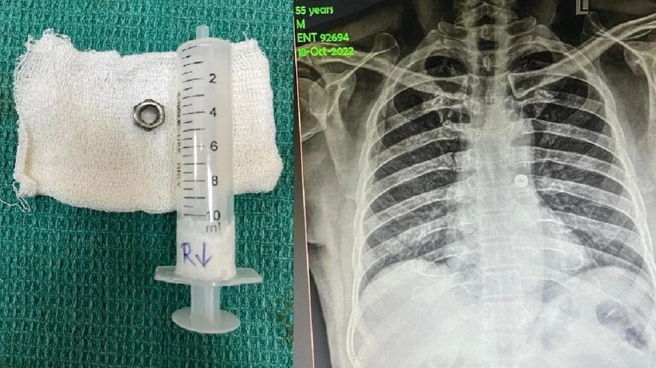 Tamil Nadu News: गलती से निगल लिया था लोहे का नट, डॉक्टरों ने ऐसे बचाई जान Tamil Nadu News: गलती से निगल लिया था लोहे का नट, डॉक्टरों ने ऐसे बचाई जान
