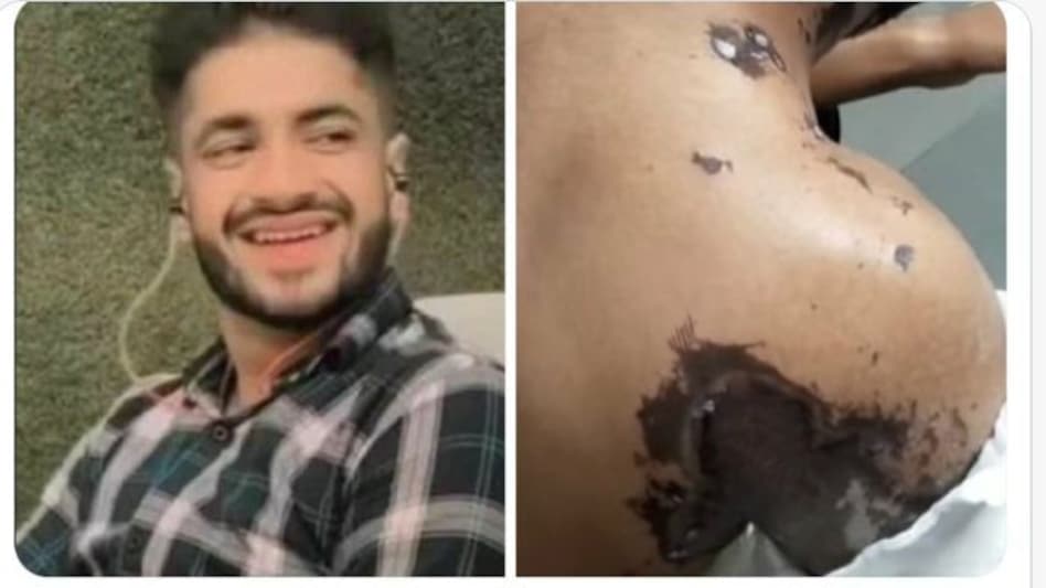 Acid Attack: शादी से किया इनकार तो प्यार में पागल लड़की ने लड़के पर फेंका एसिड Acid Attack: शादी से किया इनकार तो प्यार में पागल लड़की ने लड़के पर फेंका एसिड