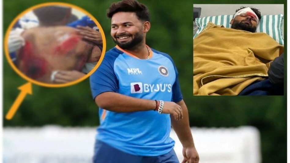Rishabh Pant Accident: ऋषभ पंत की हुई प्लास्टिक सर्जरी, सामने आई MRI रिपोर्ट Rishabh Pant Accident: ऋषभ पंत की हुई प्लास्टिक सर्जरी, सामने आई MRI रिपोर्ट
