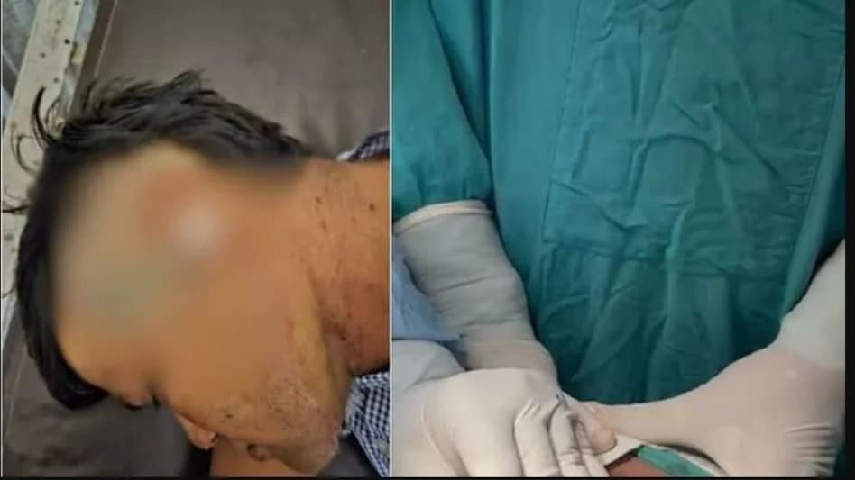 कनपटी में 7 इंच अंदर धंसा था चाकू, 45 KM का सफर करके युवक पहुंचा अस्पताल, 2 घंटे चले ऑपरेशन कनपटी में 7 इंच अंदर धंसा था चाकू, 45 KM का सफर करके युवक पहुंचा अस्पताल, 2 घंटे चले ऑपरेशन