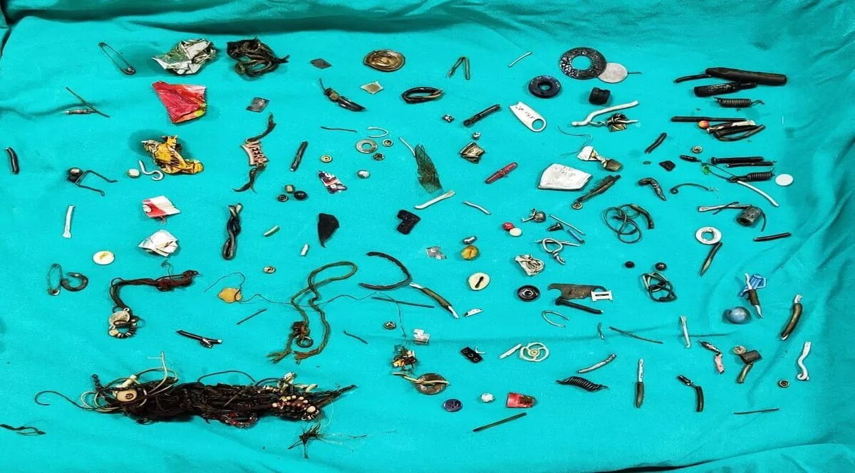 पेट का हुआ ऑपरेशन, पेट के अंदर से निकला ईयर फोन, वॉशर, नट-बोल्ट, लॉकेट और पेंच, डॉक्टर हुए हैरान पेट में ईयर फोन, नट बोल्ट, वाशर, लॉकेट और पेंच