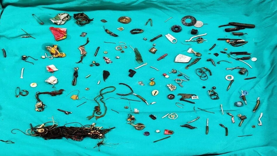 पेट का हुआ ऑपरेशन, पेट के अंदर से निकला ईयर फोन, वॉशर, नट-बोल्ट, लॉकेट और पेंच, डॉक्टर हुए हैरान पेट का हुआ ऑपरेशन, पेट के अंदर से निकला ईयर फोन, वॉशर, नट-बोल्ट, लॉकेट और पेंच, डॉक्टर हुए हैरान