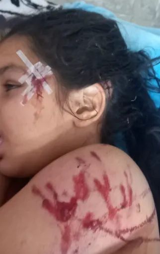 अमेरिकन बुल्ली डॉग ने सात साल की बच्ची को नोच डाला, बच्ची के शरीर के कई हिस्सों पर जख्म Delhi Dog Attack