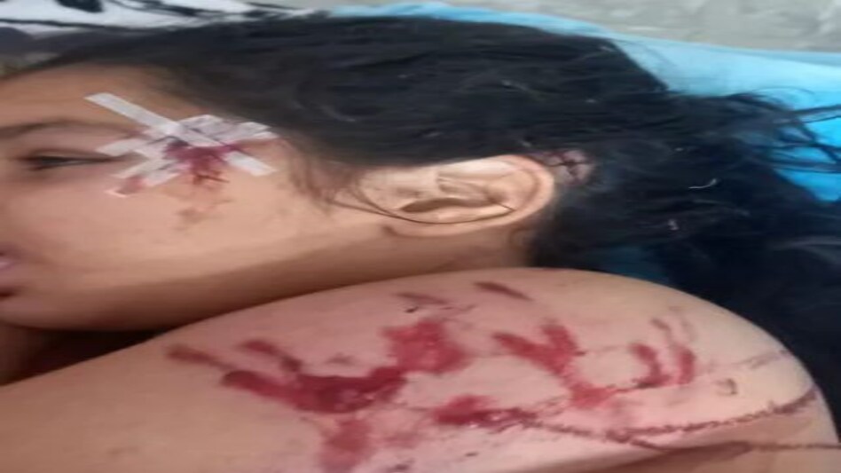 अमेरिकन बुल्ली डॉग ने सात साल की बच्ची को नोच डाला, बच्ची के शरीर के कई हिस्सों पर जख्म अमेरिकन बुल्ली डॉग ने सात साल की बच्ची को नोच डाला, बच्ची के शरीर के कई हिस्सों पर जख्म