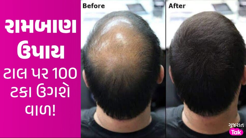 Hair growth tips: આ એક વસ્તુ ઉગાડી દેશે ટાલ પર નવા વાળ, જાણો કેવી રીતે કરવો ઉપયોગ ટાલ પર 100 ટકા ઉગશે વાળ!