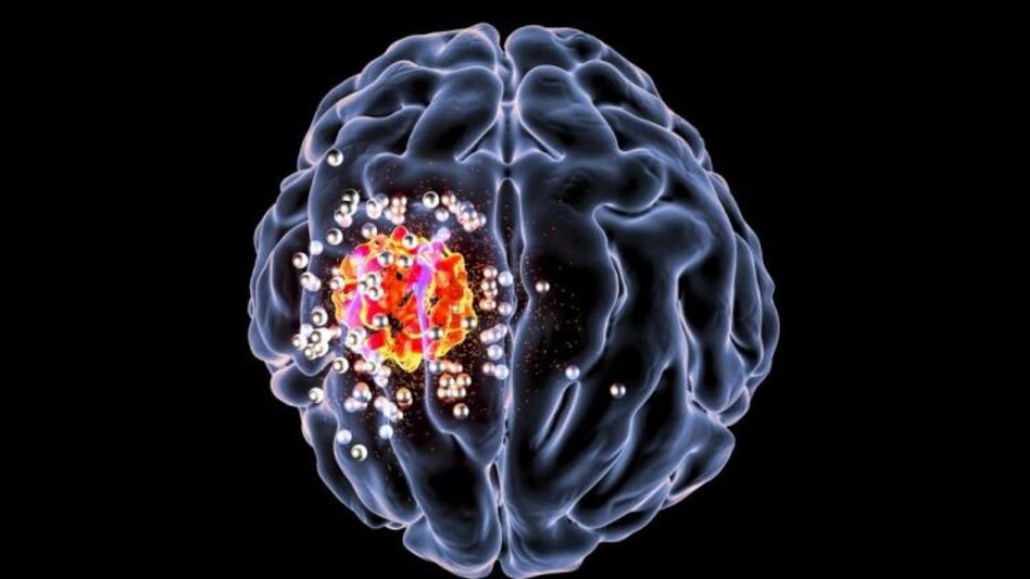 brain cancer treatment brain cancer treatment