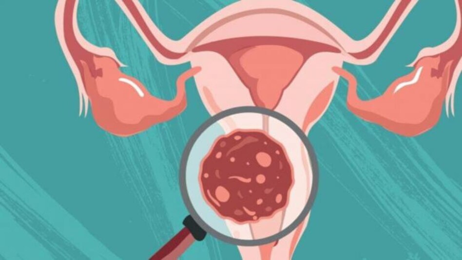 Cervical Cancer Vaccine Cervical Cancer Vaccine