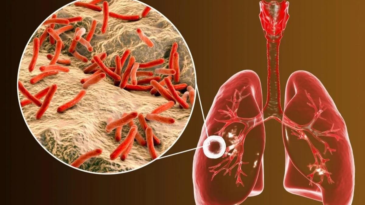 ट्यूबरक्लोसिस