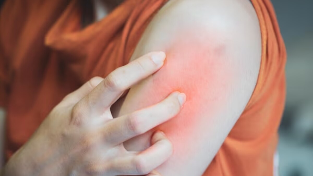 Water Allergy जानिए क्या है Aquagenic Urticaria बीमारी, जिसमें बिना