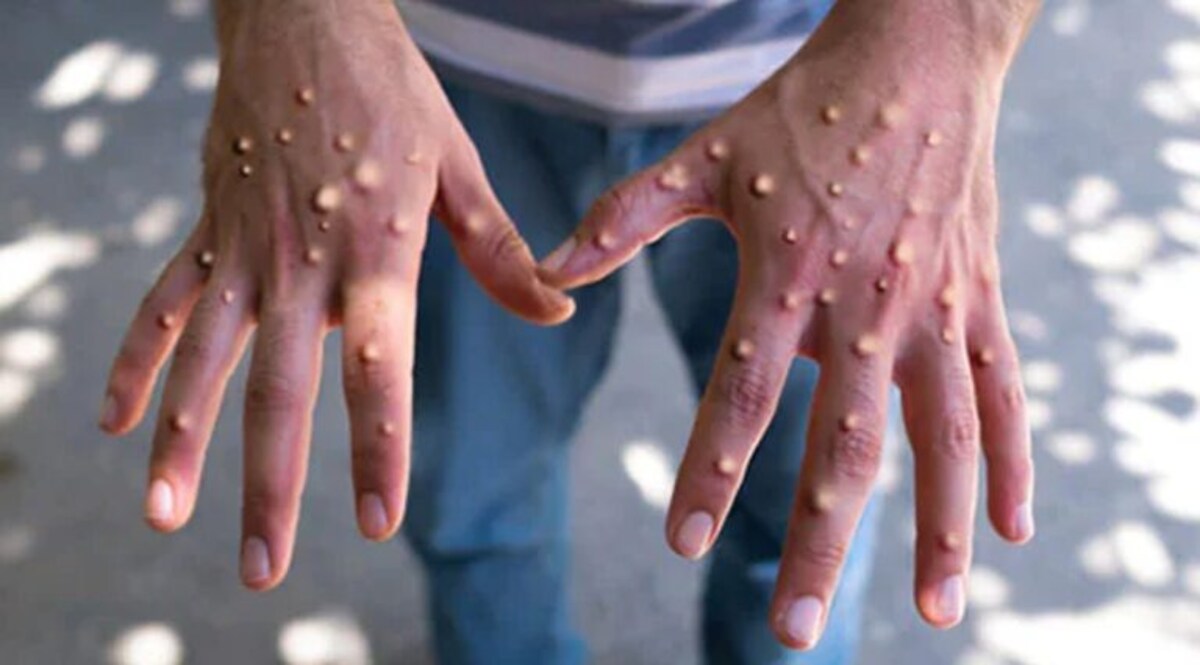 ગુજરાતમાં મંકીપોક્સનો શંકાસ્પદ કેસ મળી આવતા ચકચાર, તાત્કાલિક સેમ્પલ ટેસ્ટ માટે મોકલાયા gujarattak