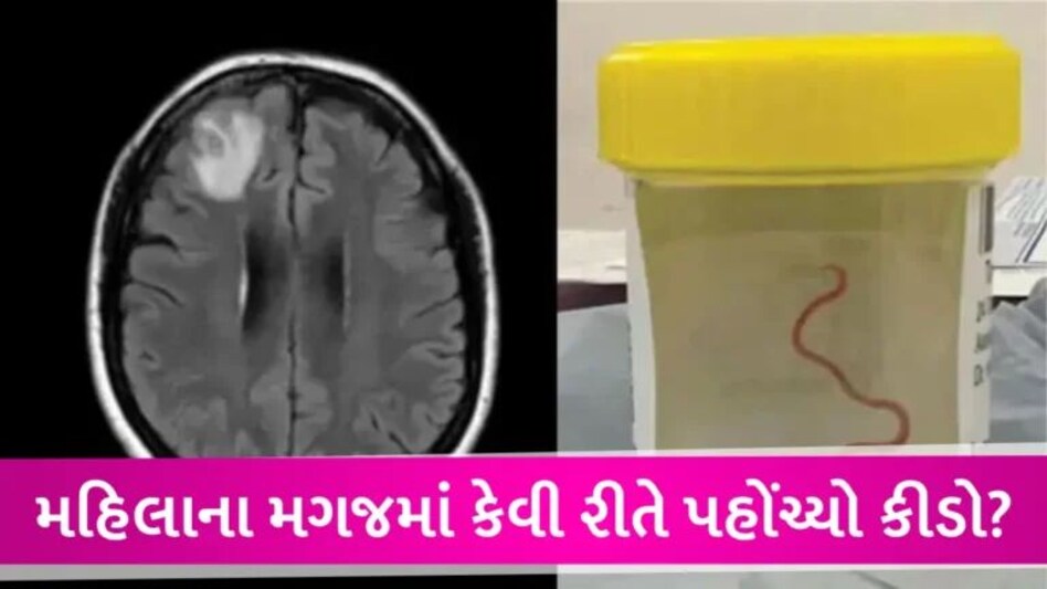 Australia News: OMG! મહિલાના મગજમાં જીવતો કીડો મળ્યો, દુનિયાનો પહેલો કેસ જોઈને ડોક્ટર્સ પણ હેરાન gujarattak