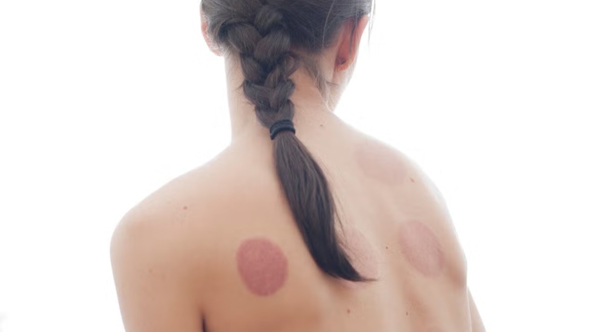 Cupping therapy