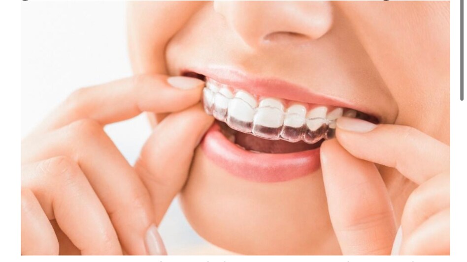 Know All About Features and Costs of Braces in India