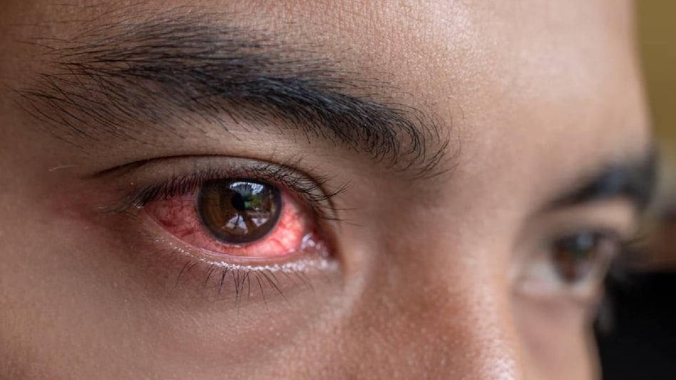 Conjunctivitis Cases Surge in India with Peak Infections Anticipated | Everything You Should Know 88 Nagaland issues advisory on conjunctivitis outbreak in India - Nagaland issues advisory on conjunctivitis outbreak in India -