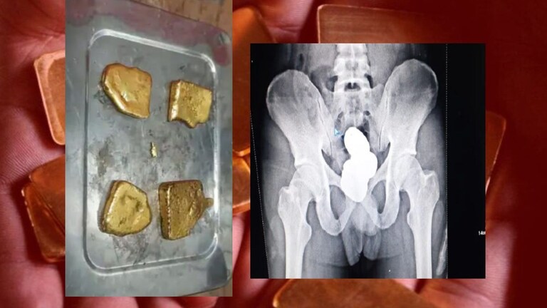 Gold Smuggling in Private Part : प्रायव्हेट पार्टमधून तस्करी, एक्स-रेमधून समोेर आला भलताच प्रकार, सोन्याचे तब्बल... प्रायव्हेट पार्टमधून सोन्याची तस्करी