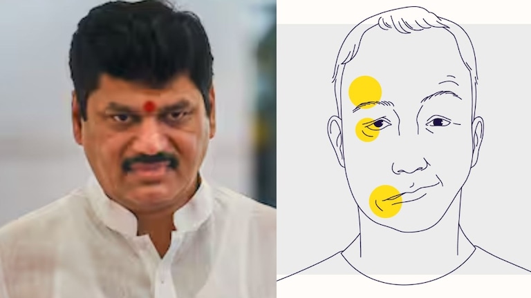 Dhananjay Munde : धनंजय मुंडे यांना झालेला Bells Palsy आजार नेमका काय? लक्षणं आणि त्रास नेमका काय? Mumbai Tak