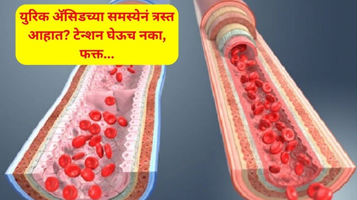 Kalonji Benefits To Reduce Uric Acid