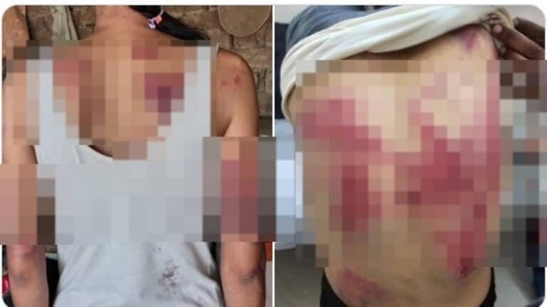 वकील महिलेची पूर्ण पाठ काळी-निळी केली, रिंगण करून मारलं.. आरोपी गावातीलच हैवान! वकील महिलेला मारहाण