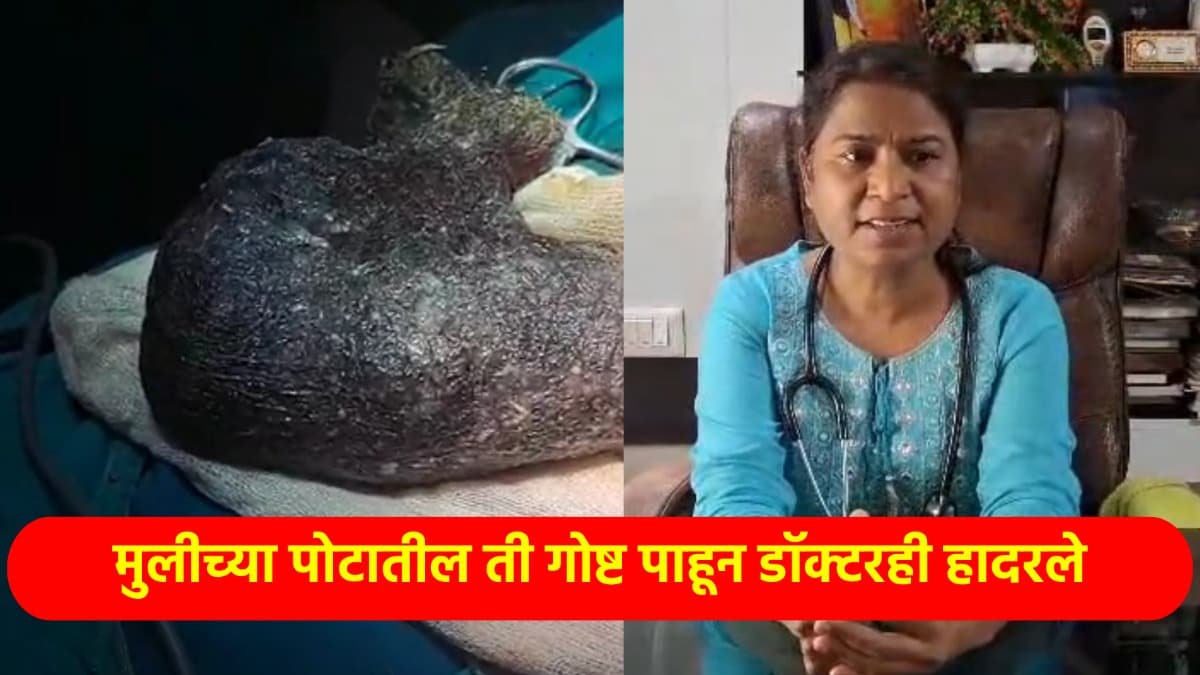 पोट दुखतं म्हणून डॉक्टरकडे नेलं, मुलीच्या पोटात आढळलं अर्धा किलो... amravati news half a kg of hair removed from 10 year old girls stomach